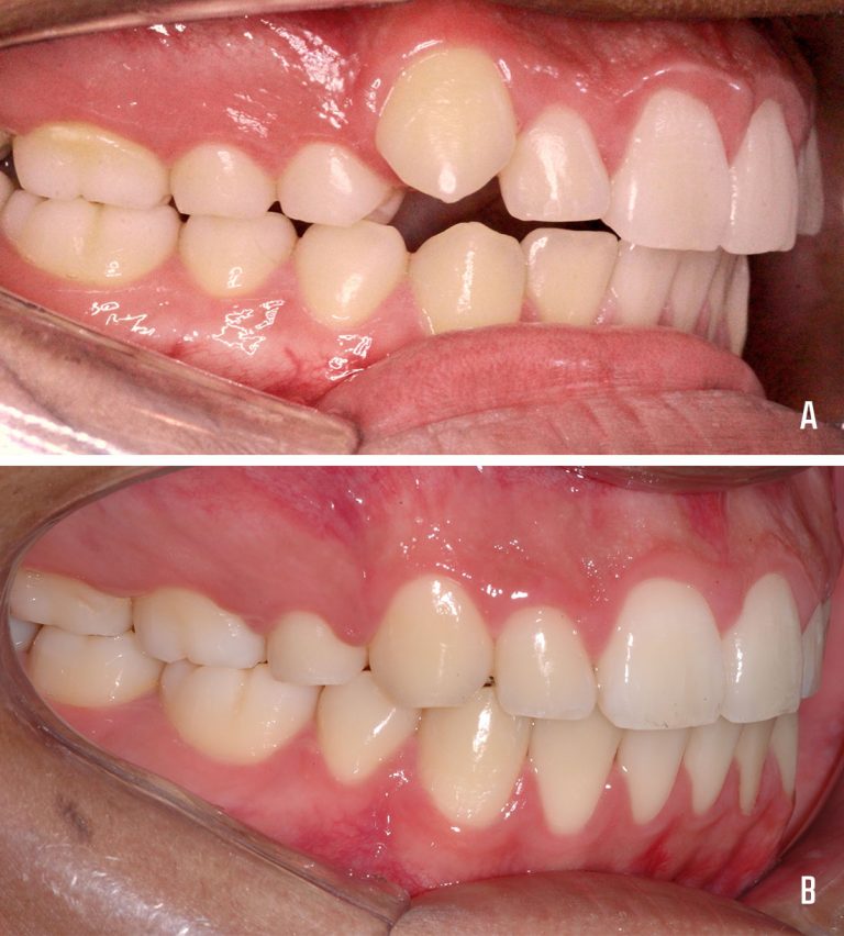 Extrações Dentárias Na Ortodontia 1539