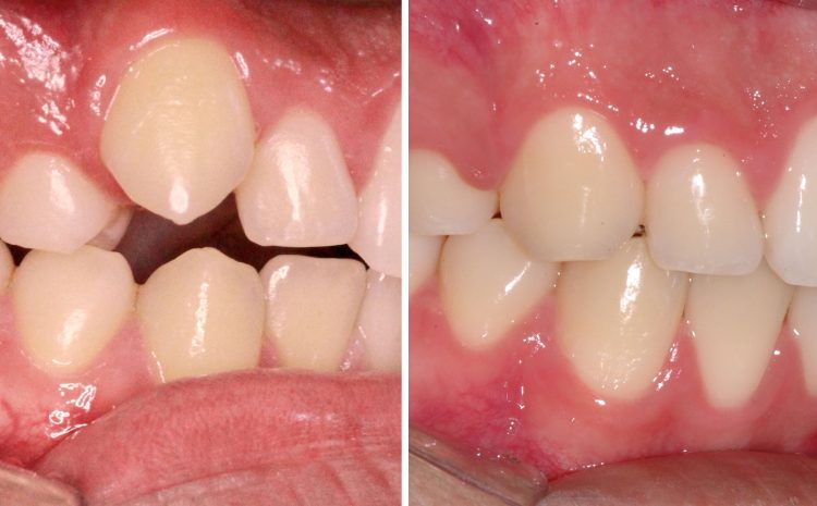 Extrações dentárias na Ortodontia.