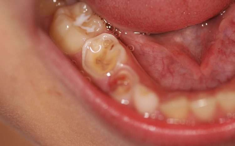 Erosão Dentária em Crianças e Adolescentes