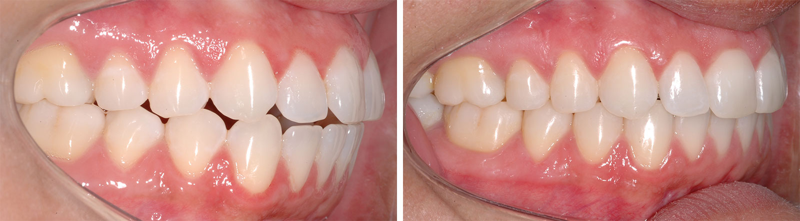 Manutenção do aparelho dental fixo: saiba tudo sobre essa etapa do